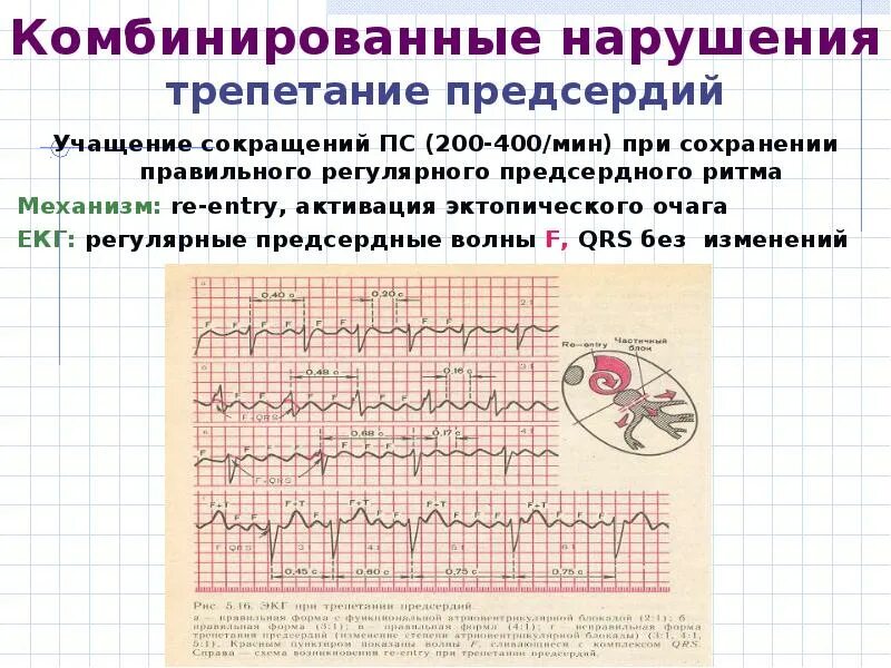 Трепетание предсердий очаг. Трепетание предсердий 1:1. Трепетание предсердий 2 к 1 на ЭКГ. Эктопический предсердный ритм. Эктопический предсердный ритм что это