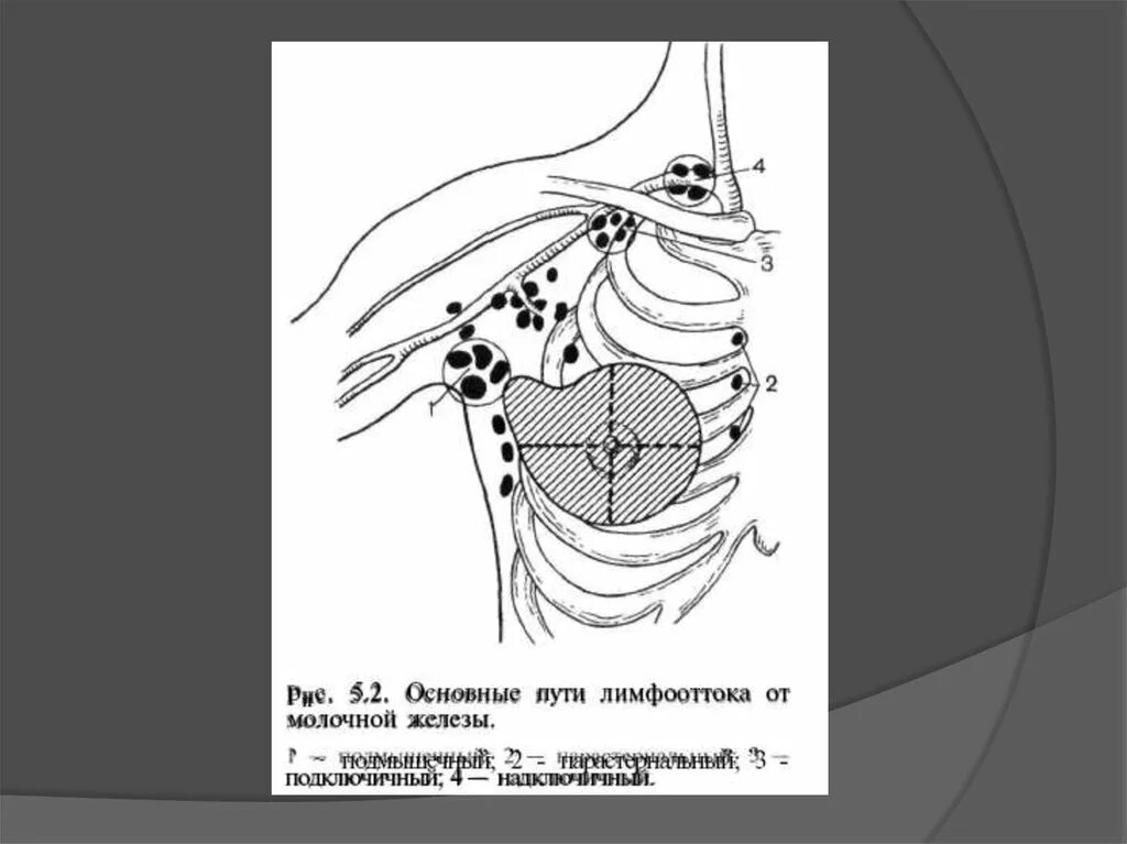 Гнойные заболевания железистых органов. «Гнойные заболевания железистых органов. Мастит». Интрамаммарные лимфоузлы. Интрамаммарный доступ. Увеличен лимфоузел в молочной железе