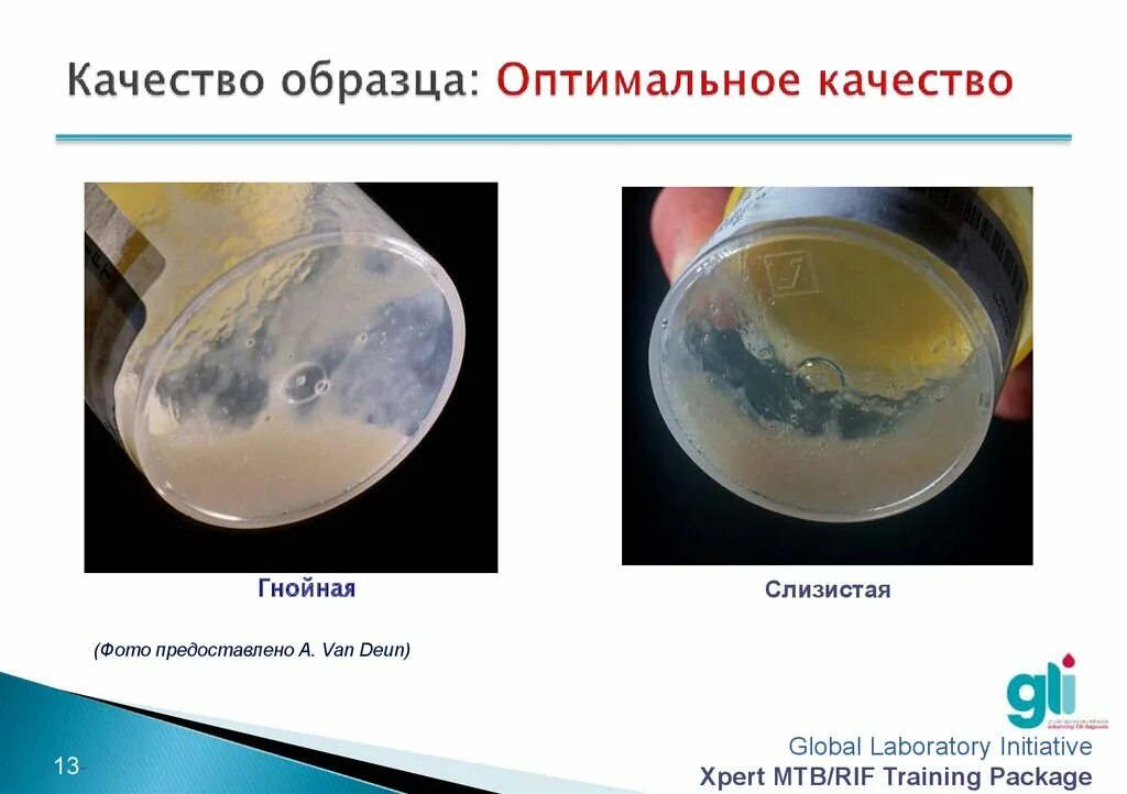 Ежедневная мокрота. Количество мокроты.