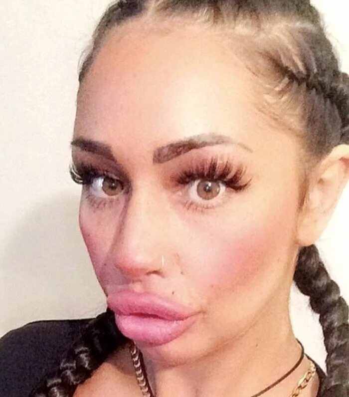 Накаченные силиконом губы. Накаченные губы до и после. Девушки с надыми губами. Губы накаченные ботоксом. Девушки губы ботокс.