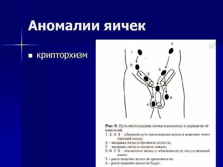 Крипторхизм у детей клинические рекомендации. Двусторонний крипторхизм паховая форма. Двусторонний ложный крипторхизм. Крипторхизм патогенез. Крипторхизм лечение