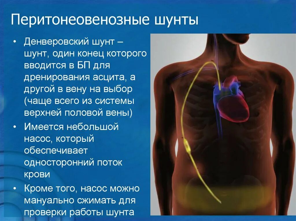 Внутреннее перитонеовенозное шунтирование. Перитонеовенозный шунт при асците брюшной полости. Перитонеовенозное шунтирование при асците.