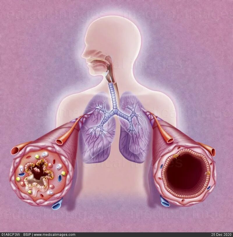 Бронхит 2024. Обструкция дыхательных путей бронхиальная астма. Бронхиальная астма легкие.