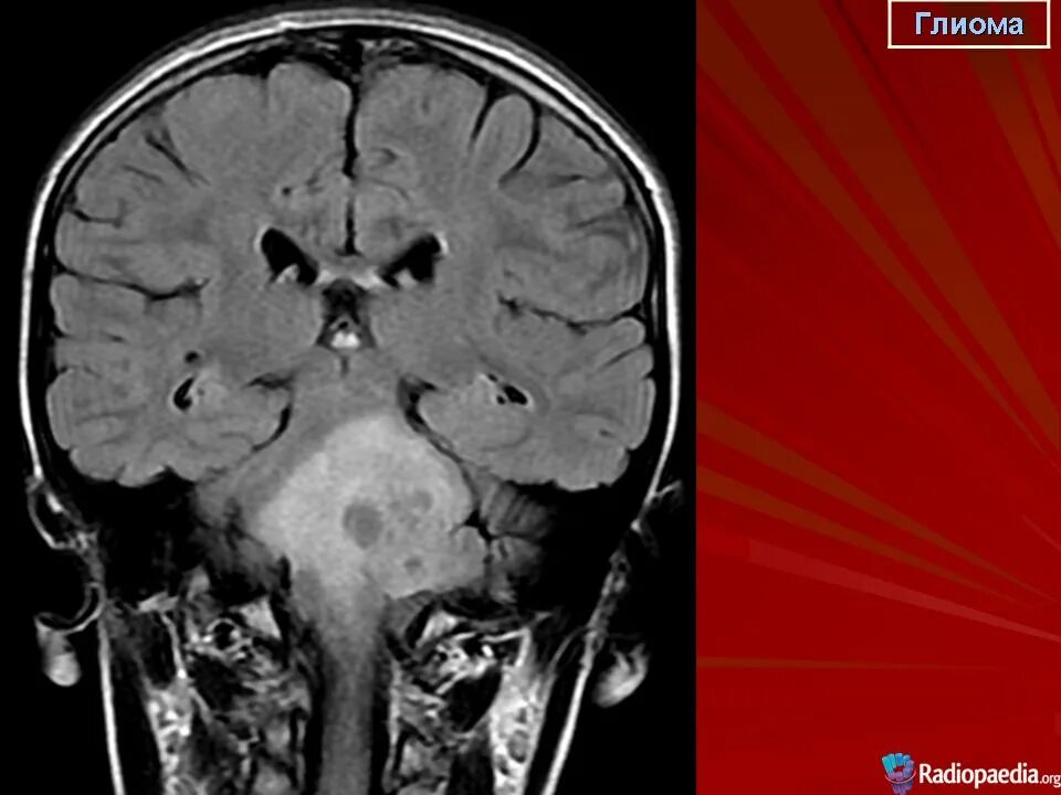 Глиома у детей. Глиома ствола головного мозга. Диффузная глиома ствола мозга. Глиома ствола головного мозга мрт.