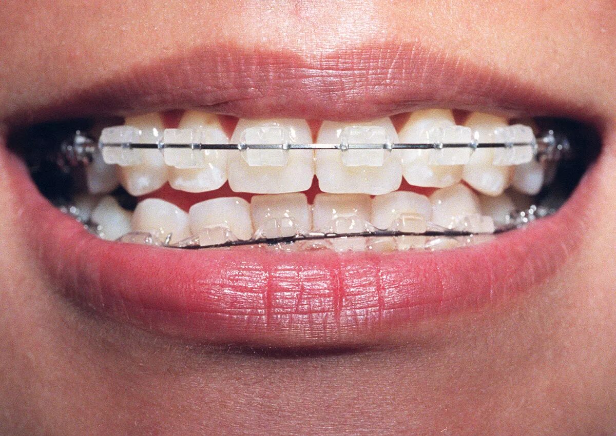 Сколько стоят брекеты в самаре. Брекеты сапфировые настоящее фото. cheap dental. почему брекеты сушат кожу.