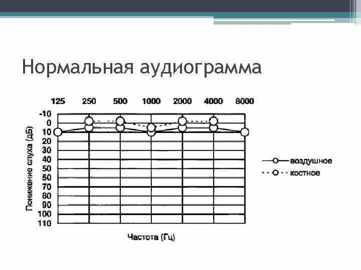 Аудиограмма норма