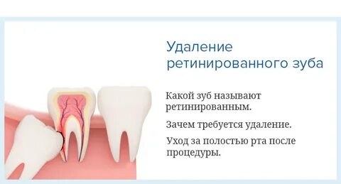 Удаление зуба мкб