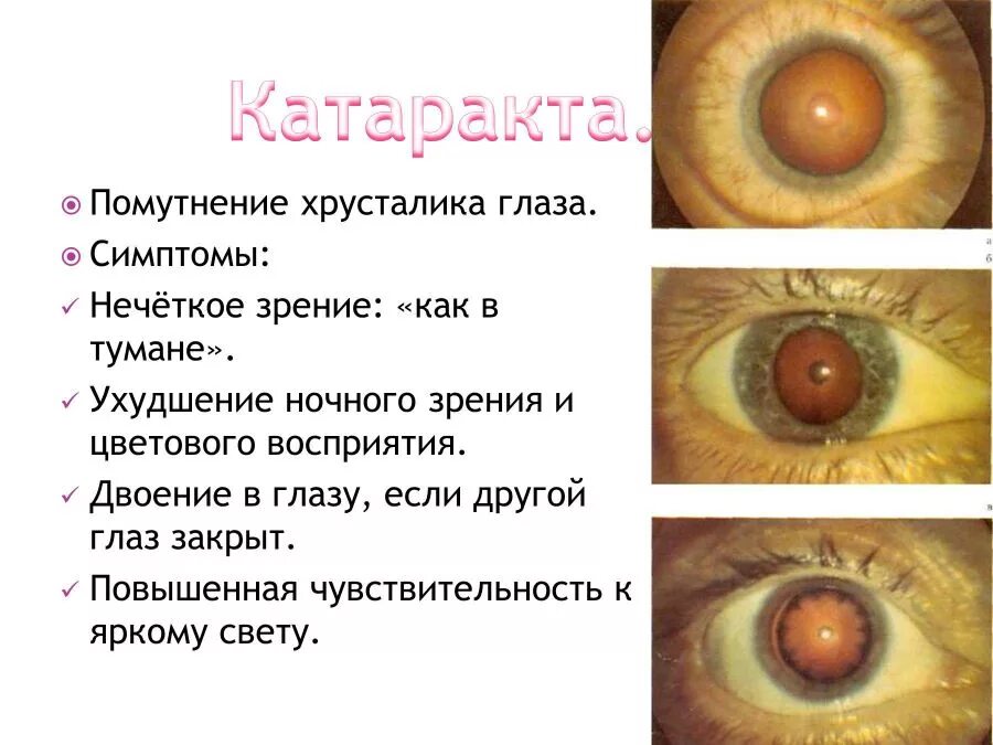 Катаракта на правом глазу. Глазные болезни катаракта таблица. помутнение хрусталика симптомы. катаракта схема глаза. лечится ли катаракта глаза у человека.