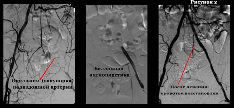 Тромбоз артерии лечение. Балонная ангиопластика сосудов нижних конечностей. Баллонная ангиопластика бедренной артерии. Хроническая окклюзия артерий. Стентирование бедренной артерии.