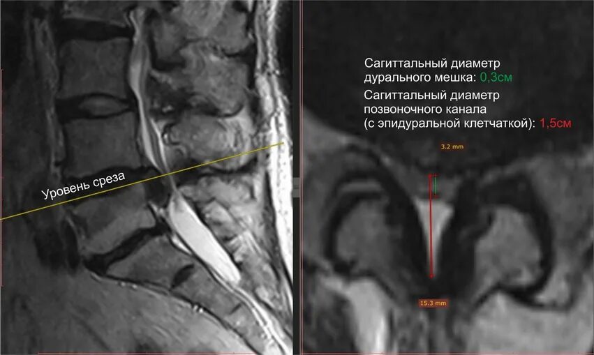 Дуральный мешок деформирован пояснично крестцового. Грыжи деформирующие дуральный мешок. Деформация дуральный мешок позвоночника. Грыжи деформирующие дуральный мешок. Дуральный мешок деформирован шейный отдел.