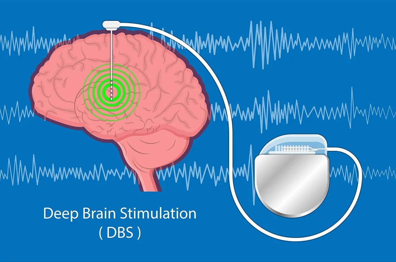 Как стимулировать мозг. Стимуляция мозга. Глубокая стимуляция мозга DBS. НАУ Брейн Стимулейшн.
