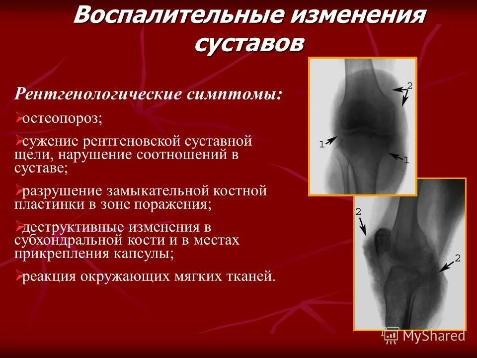 Воспалительные заболевания суставов классификация. Рентген признаки ревматоидного артрита суставов кисти. Рентгенологические симптомы патологии суставов. Воспалительные изменения суставов. Сужение рентгеновской суставной щели.