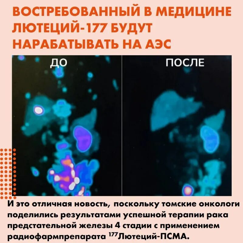 стадии онкологии предстательной железы. опухоли предстательной железы классификация. диета при онкологии 4 стадии с метастазами. онкология простаты 4 степени. метастазы в предстательной железе.