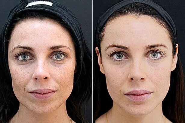 Pin by Afomya on bad chenge Celebrity plastic surgery, Plastic surgery, Implants