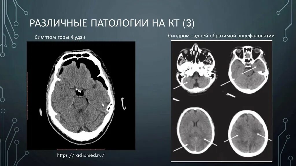 Энцефалопатия на кт. Синдром задней обратимой энцефалопатии. Бас неврология на кт. Кт в неврологии показания. Н 3 кт