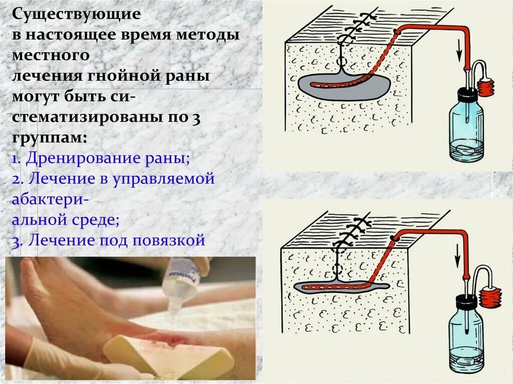 Обработка гнойной раны алгоритм. Дренирование раны обработка. Обработка гнойной раны в фазе дегидратации. Алгоритм проведения перевязки гнойной раны. Алгоритм гнойной раны