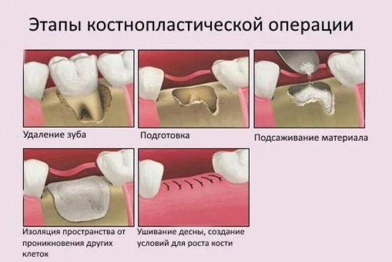 Какие зубы удаляют