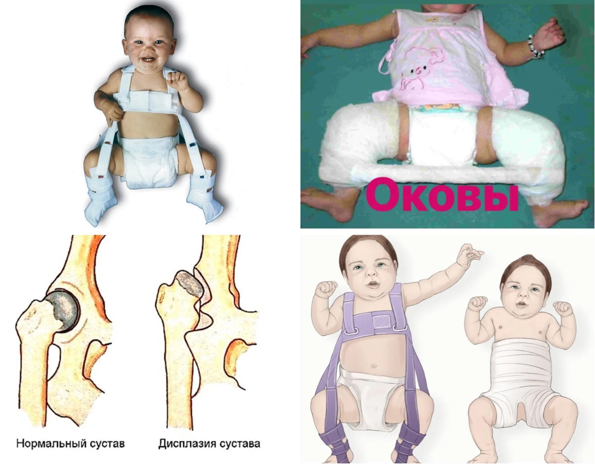 Дисплазия сустава у новорожденного лечение. Дисплазия тазобедренных суставов. Дисплазия тазобедренных суставов у новорожденных.