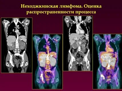 Заболеваемость лимфомами