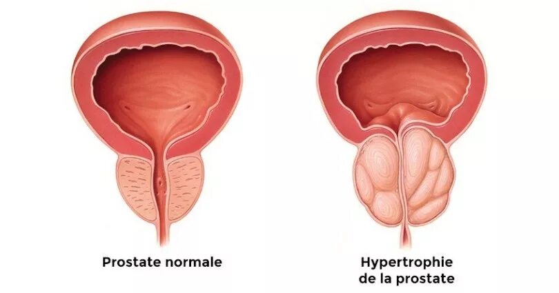 Хроническая простата аденома. Воспаление уретры у мужчин.