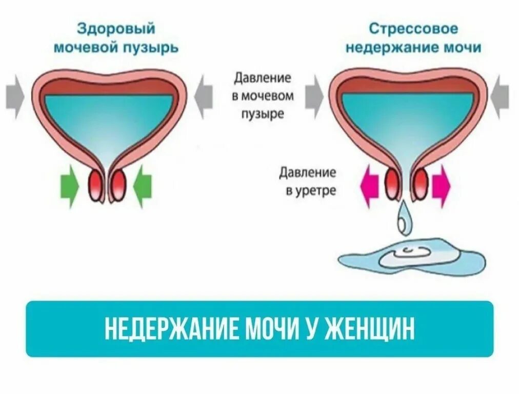 Недержание мочеиспускания у мужчин