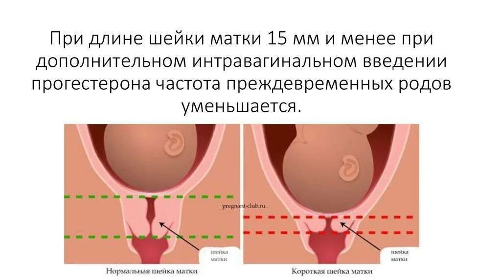 При короткой шейки матки при беременности. Нормальная шейка короткая шейка матки. Укоротилась шейка матки при беременности. Цервикальный канал размеры