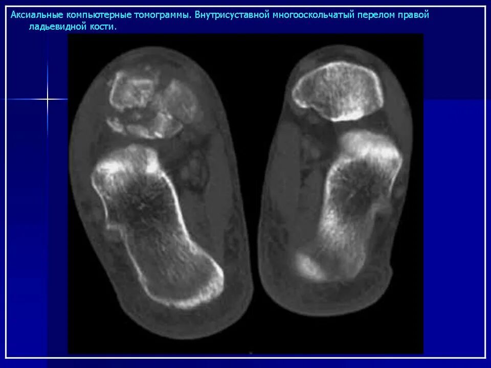 Контузионные изменения таранной кости. Некроз таранной кости рентген. Асептический некроз таранной кости. Таранная кость контузия. Контузионные изменения кости