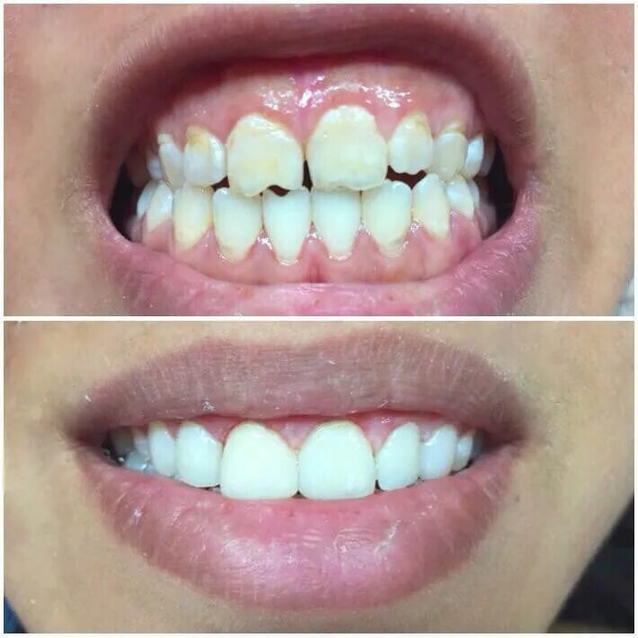 Реконструкция переднего зуба. Композитное наращивание зубов. Зубы можно реставрировать. Художественное наращивание зубов. Художественная реставрация зуба.