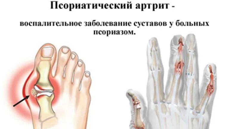 Воспаление артрит лечение. Воспаление артрит лечение. Подагревыи артрит стопы. Инфекционные артропатии патогенез. Остеоартрит и ревматоидный артрит.