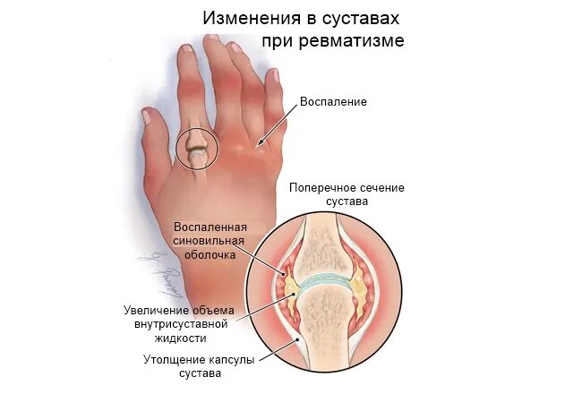 Ревматическое поражение суставов