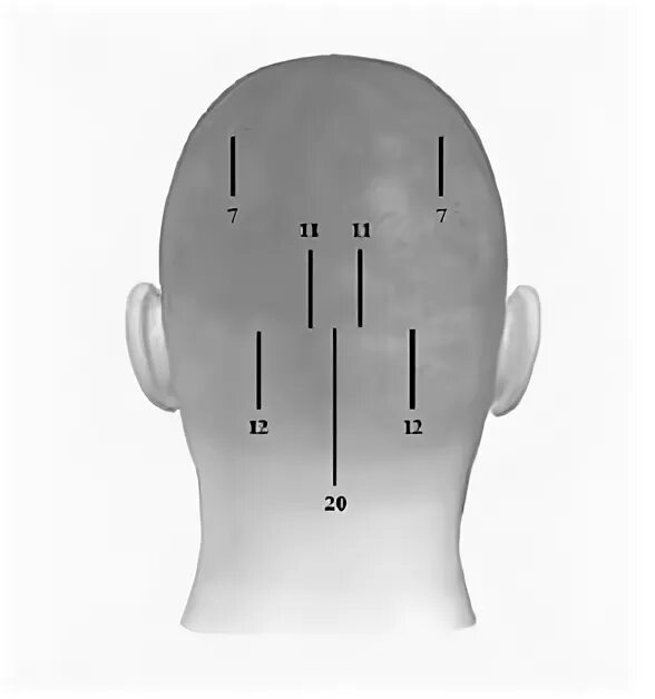 какой автор предложил краниопунктуру скальптерапию