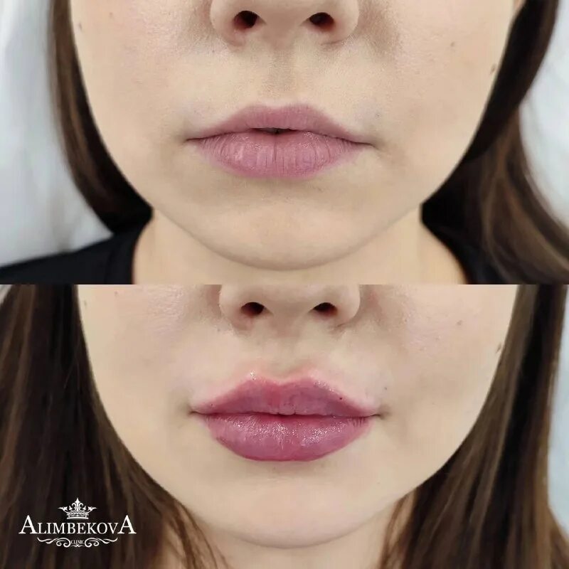 Эффект зацелованных губ процедура. Qt fill губы. Qt fill губы. Qt deep филлер. Qt fill филлер.