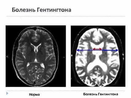 Болезнь хантингтона