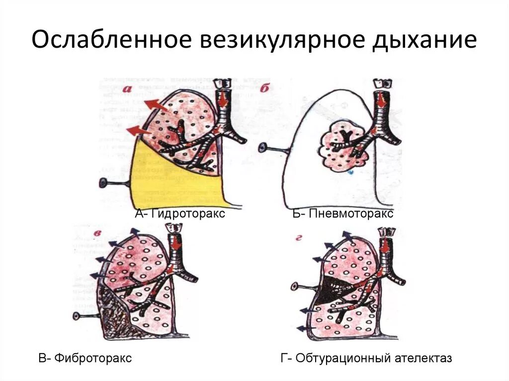 Пропедевтика внутренних болезней везикулярное дыхание. Ослабление вкзикульрное дыхание. Ослабление везикулярного дыхания. Везикулярное дыхание.