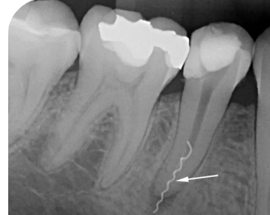 Периодонтит вкладка рентген. Апикальный периодонтит. Временное пломбирование корневых