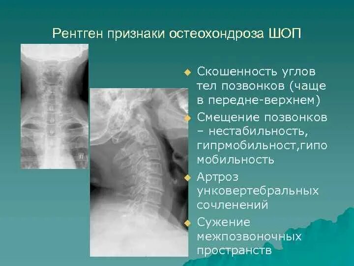 Шейный отдел позвоночника диагнозы. Остеохондроз шейного отдела 1 степени рентген. Остеохондроз шейного отдела позвоночника рентген. Стадии остеохондроза шейного отдела позвоночника рентген. Остеохондроз грудного отдела степени рентген.