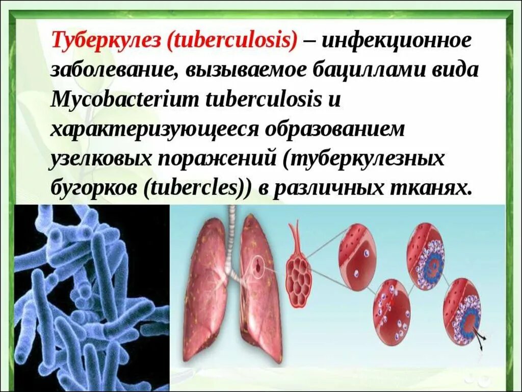Как называли туберкулез
