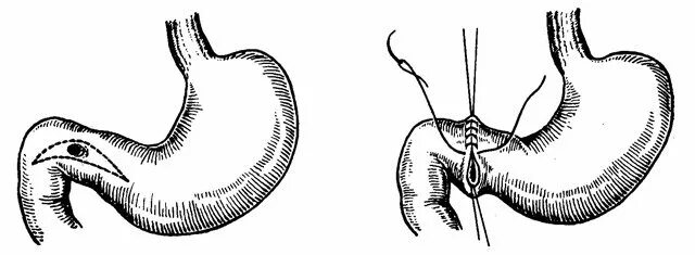 Перфоративная язва желудка. Прободная и перфоративная язва. Проводная язва желудка. Перфорация язвы ДПК операция.