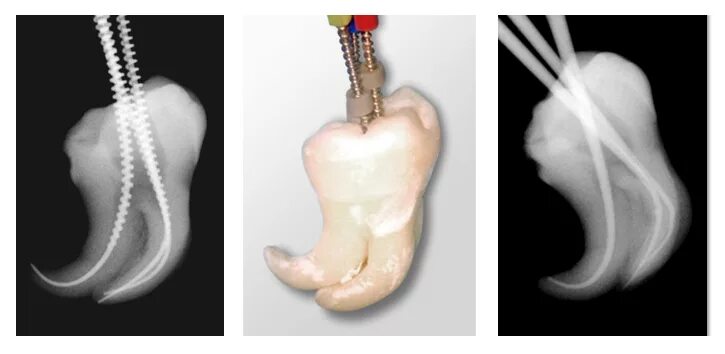 Препарирование корневого канала. Эндодонтия рентген пломбировка. Эндодонтия 2.5. Расширение зубного канала.
