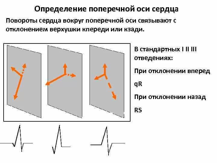 ЭКГ при поворотах сердца вокруг продольной оси. Определение поворотов сердца вокруг продольной оси на ЭКГ. Поворот сердца вокруг поперечной оси. Повороты сердца на ЭКГ вокруг продольной оси. Поворот правым желудочком вперед