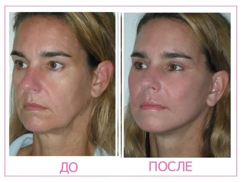 Массаж лица эффект. Массаж лица для подтяжки до и после. Lpg массаж лица до и после. Lpg массаж лица эффект до и после. Массаж лица до и после.