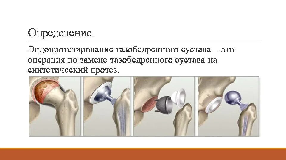 Операция эндопротезирование тазобедренного сустава схема. Эндопротезирование тазобедренного сустава реабилитация. Биполярное эндопротезирование тазобедренного сустава. Гибридное эндопротезирование тазобедренного сустава. Эндопротезирование тазобедренного отзывы пациентов