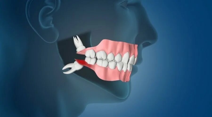 Рудименты человека зубы мудрости. Как долго растут зубы мудрости