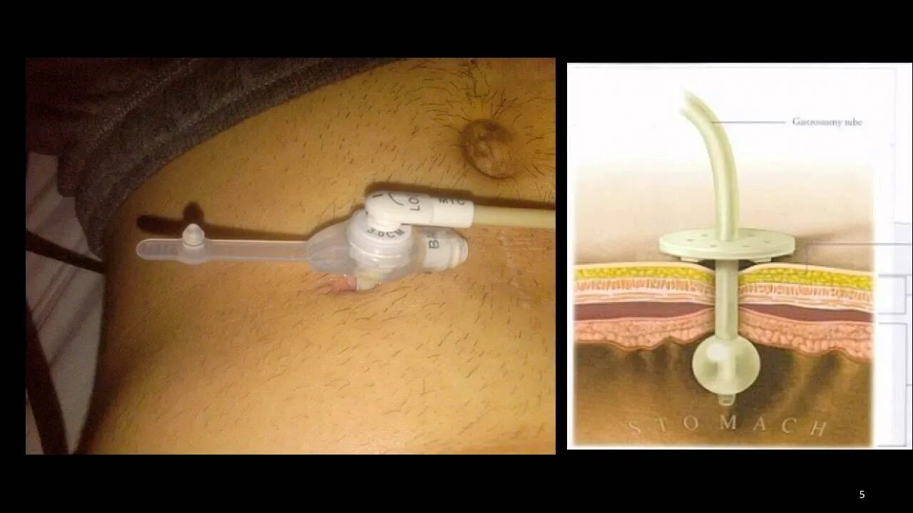 Гастростома катетер фолея. Гастростома peg. Стома (колостома/илеостома). Трубка в животе. Нефростома 16сн.