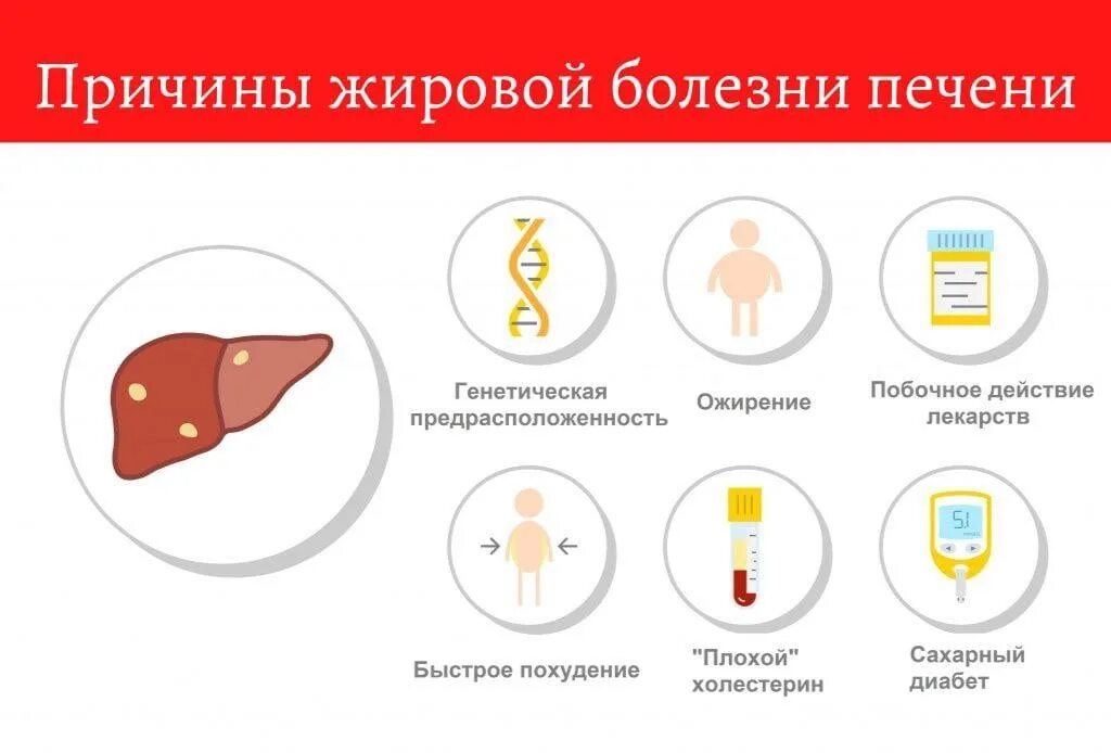 5 причин печень. Причины жирового гепатоза. Жировой гепатоз печени. Жировой гепатоз и ожирение печени.