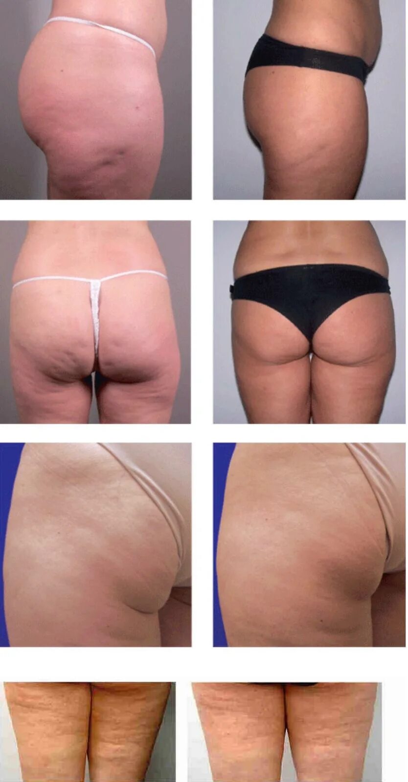 Ультразвуковая кавитация живота. Без тела отзывы. Ультразвуковая кавитация до и после. Ультразвуковая кавитация результат. Кавитация и липосоникс что это.