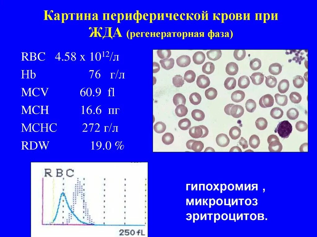 Анемия количество эритроцитов. При микроскопии эритроцитов при железодефицитной анемии. Картина крови при железодефицитной анемии. Картина периферической крови при жда. Изменение эритроцитов при железодефицитной анемии.