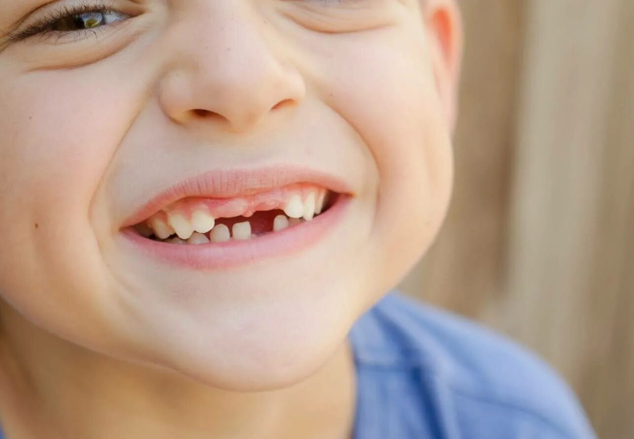 молочные передние выпали растут. молочные передние выпали растут. выпадают молочные зубы у ребенка. выпадение молочных зубов. выпадение молочных зубов.