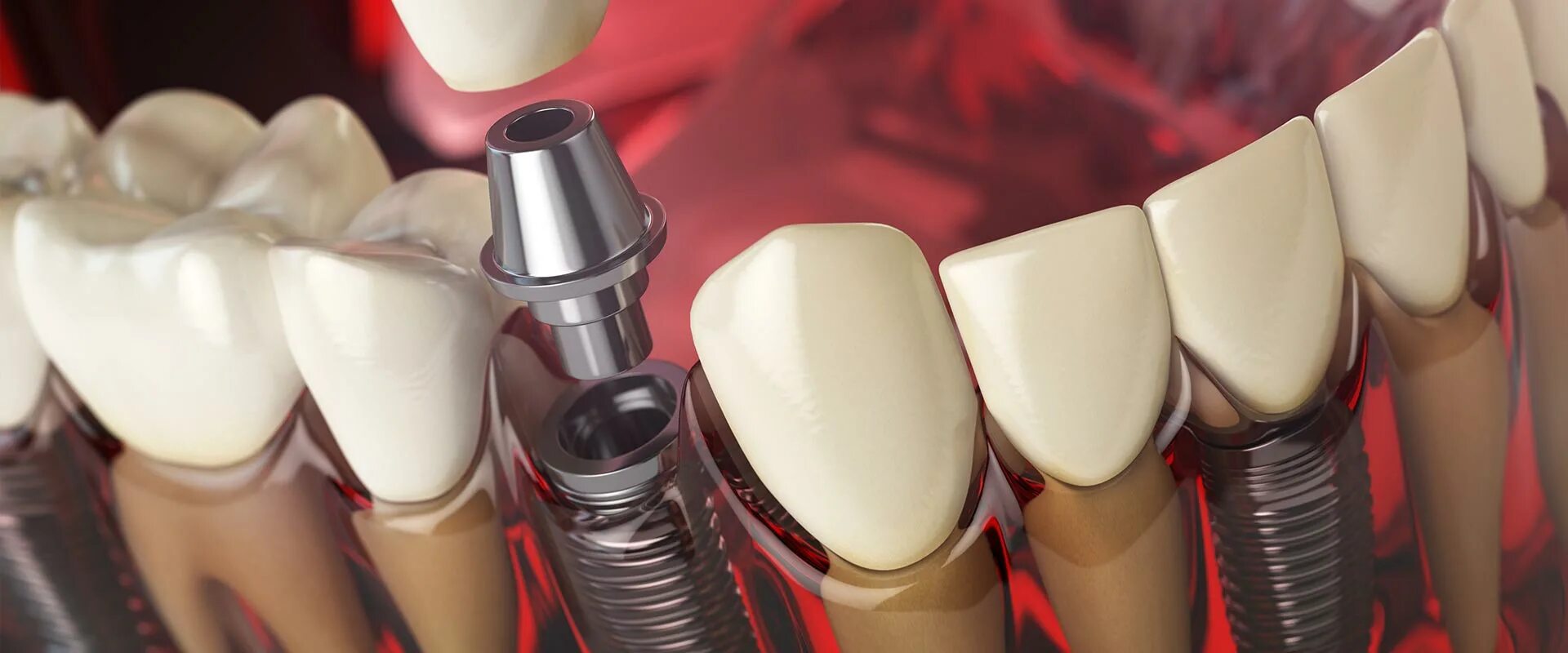 комбинированная имплантация зубов. 5 h10rf. зубной имплант красноярск. имплант osstem + имплантация. Nobel biocare имплантаты.