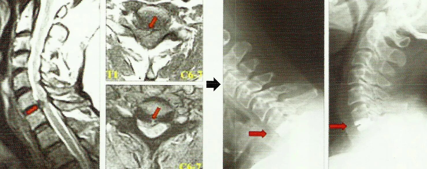 Миелопатия шейного отдела. Стеноз канала шейного отдела операция. Цервикальная миелопатия. Стеноз шейных позвонков. Шейная грыжа операция отзывы